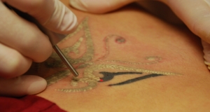 Tattoo verwijderen