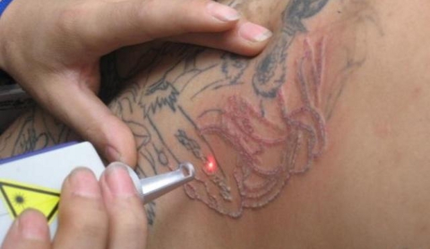 Tattoo verwijderen met laser